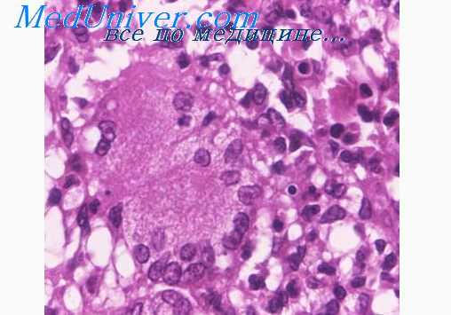 гриппозная пневмония