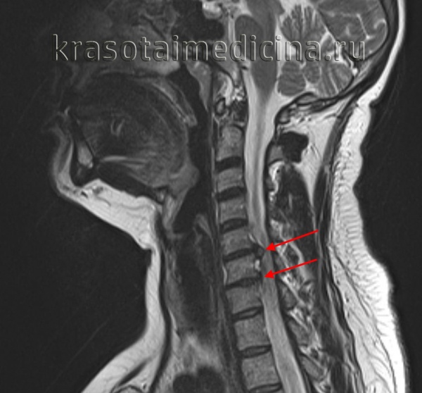 Межпозвоночная грыжа шейного отдела