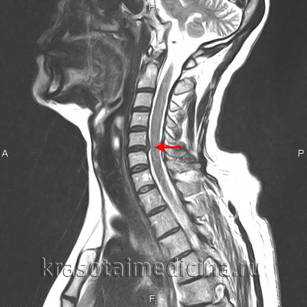 Межпозвоночная грыжа