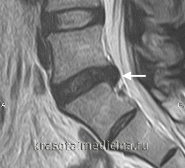 МРТ поясничного отдела позвоночника. Грыжа межпозвонкового диска в сегменте L5-S1