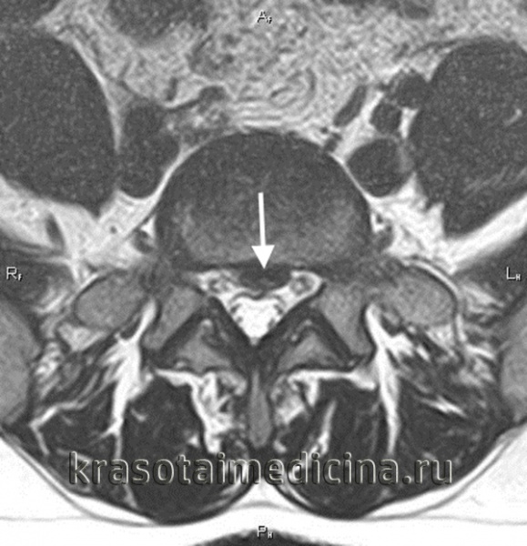 Межпозвоночная грыжа шейного отдела