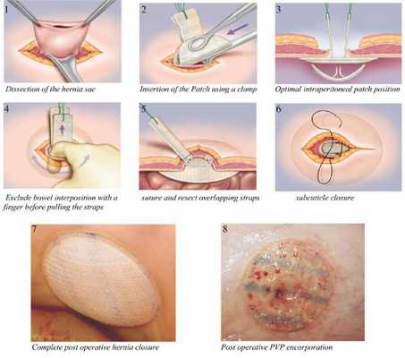 Установление протеза для укрепления брюшной стенки