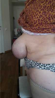 Изменение брюшной стенки, указывающее на грыжу