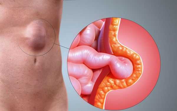 Прорыв апоневроза брюшной стенки и выпадение петли кишечника