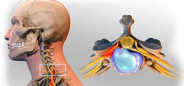 Операция на шейном отделе позвоночника