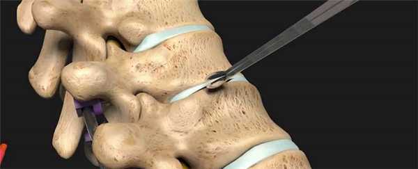 Дискэктомия - операция при грыже позвоночника