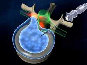 Нуклеопластика - операция при грыже позвоночника