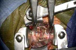 Операции на позвоночнике