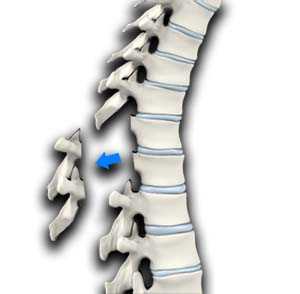 Ламинэктомия - операция при грыже позвоночника