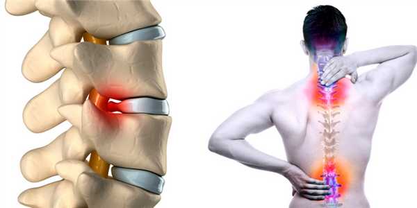 Внутри-спинномозговая грыжа