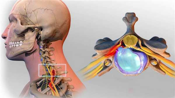 Грыжа диска шейного отдела позвоночника