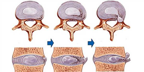 Этапы формирования грыжи диска