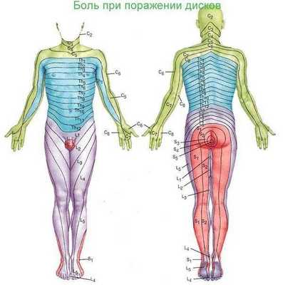 Иррадиация болей при поражении различных спинномозговых нервов