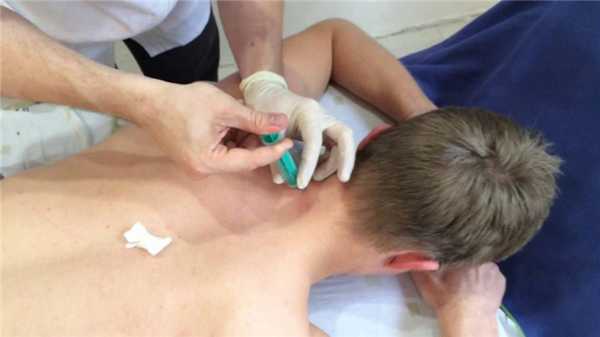 Блокада шейного отдела позвоночника