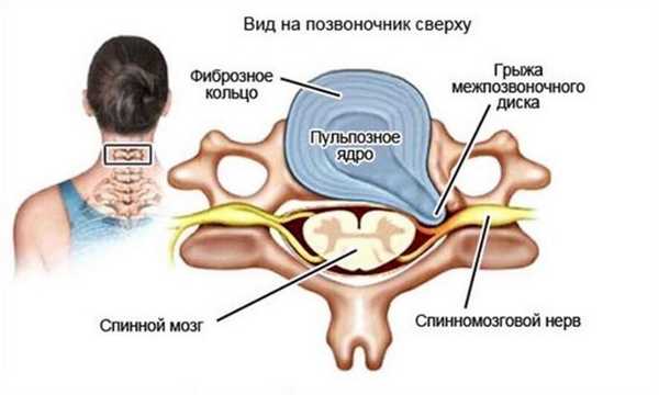 Строение межпозвоночного диска и грыжа