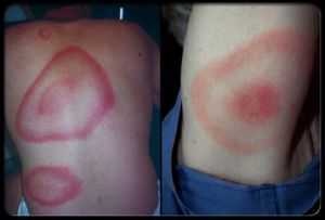 рана после укуса клеща