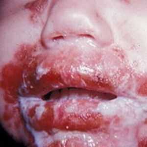 акродерматит