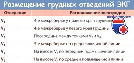 Размещение электродов грудных отведений ЭКГ