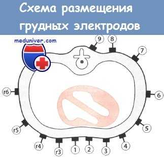 Размещение электродов грудных отведений ЭКГ