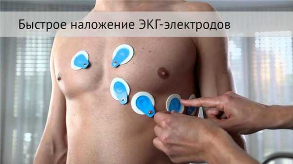 Быстрое наложение электродов ЭКГ