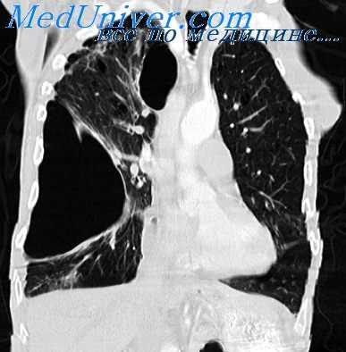 плевральные сращения