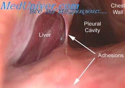 плевральные сращения