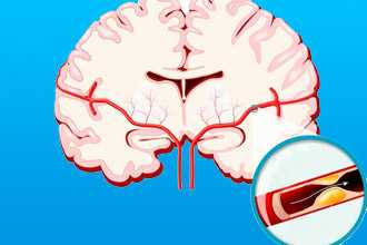 Атеросклероз