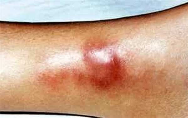 бугорок на ноге при третичном сифилисе