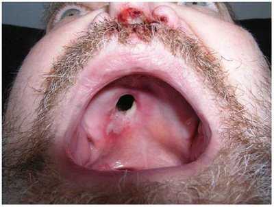 разрушение твердого неба при третичном сифилисе