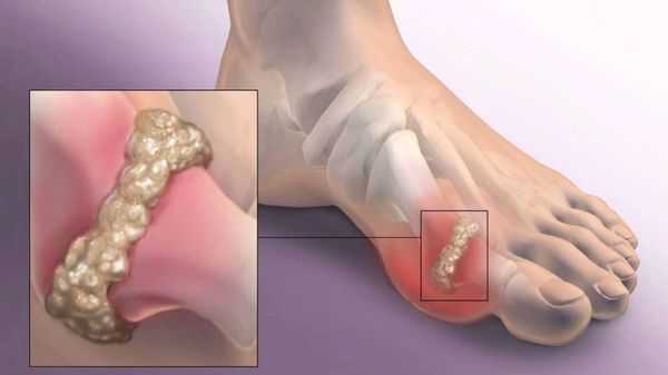 Артроз первого плюснефалангового сустава