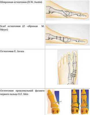 Схематичное изображение наиболее часто используемых видов операций по коррекции Hallux Valgus