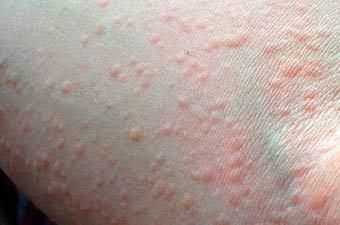 Волдыри крапивницы