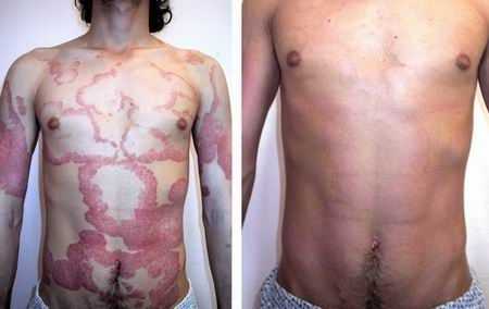 Основной симптом крапивницы: исчезновение сыпи через 1-2 дня