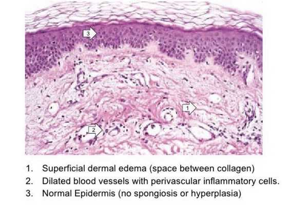 Гистология кожи при крапивнице