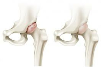 Соединение в единую тазовую кость образуется седалищной, подвздошной и лобковой костями. А полусферическая выемка, создаваемая ими, называется вертлужная впадина. Вместе с головкой бедренной кости эта часть скелета обеспечивает опорную и двигательную функции. Травмы, полученные в этой области, могут стать причиной существенного снижения качества жизни. Рассмотрим подробнее ее строение и какие травмы, и патологии могут быть.