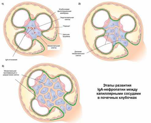 Этапы болезни Берже