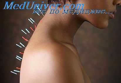 акупунктура при абстиненции