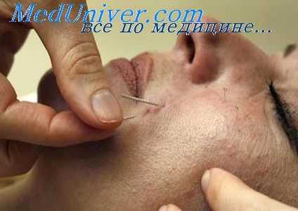 иглорефлексотерапи в наркологии