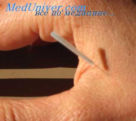 акупунктура при кардиалгии