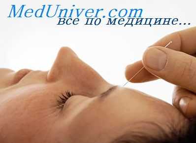 иглорефлексотерапия при болях в сердце