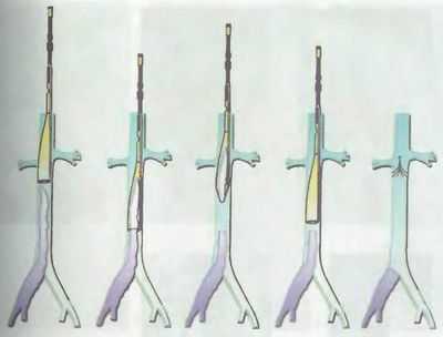 Эндоваскулярная катетерная тромбэктомия (ЭКТ) из нижней полой и подвздошных вен