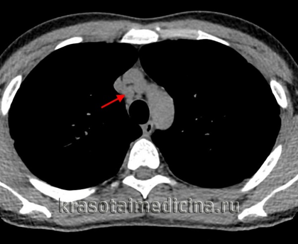 Муковисцидоз легких