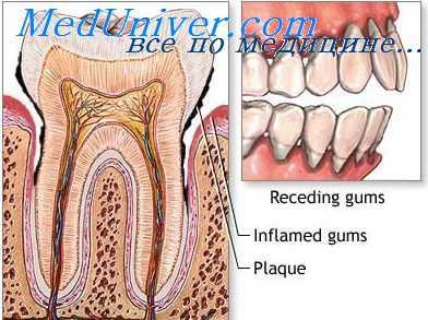 разрушение пародонта