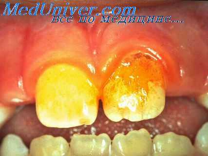 болезни пародонта