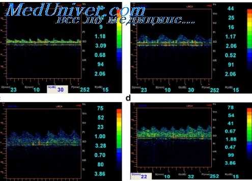 допплерография сосудов мозга