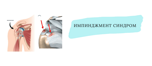 импинджмент синдром.png