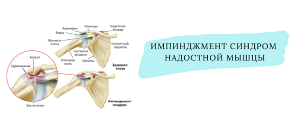 импинджмент синдром надостной мышцы.png