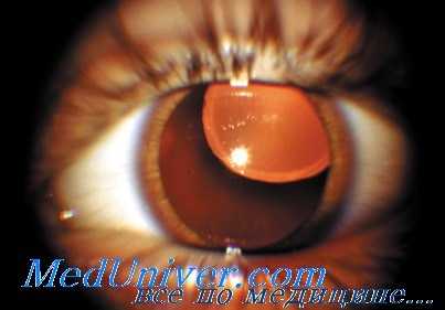 дислокация хрусталиковых масс