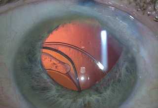 Дислокация ИОЛ после удаления катаракты