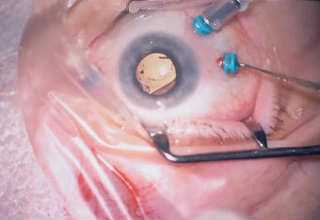 Репозиция ИОЛ